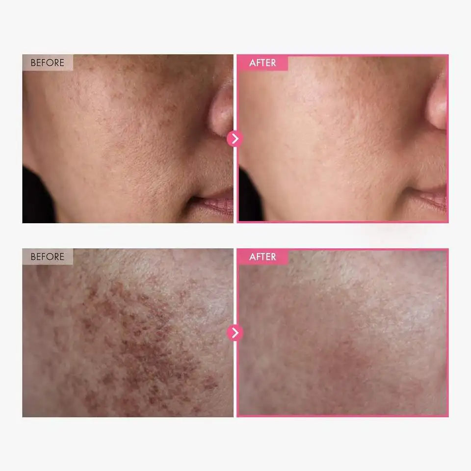 TOSOWOONG Arbutin 7% + TXA 4% Creme 50ml Koreanische Hautpflege Dunkle Flecken Entferner Ebenmäßiger Hautton Aufhellende Gesichtscreme